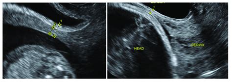 measurement of lower uterine segment thickness|scar thickness usg.